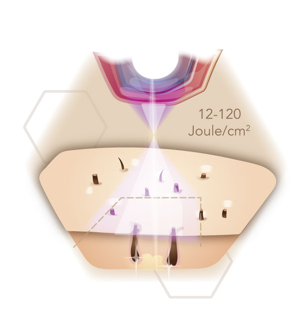 Infografik der Wirkung des Lichts von IPL auf die Haut - Angabe der wirkenden Energie